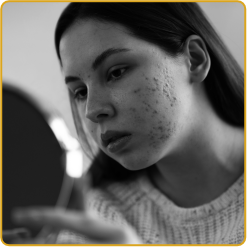 Acne-pron