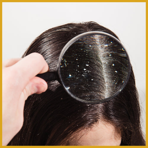 Dandruff & hairfall
